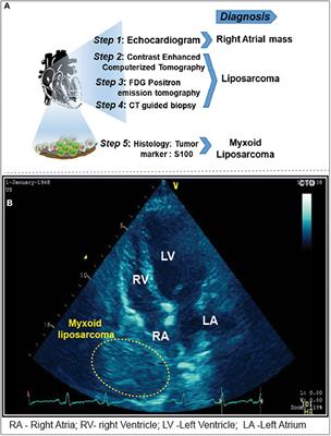Case report: Metastatic myxoid liposarcoma arising from the right atrium extends as cardiac tamponade—A rare case of atrial oncology